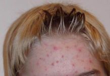 Does your acne lead to mental distress?